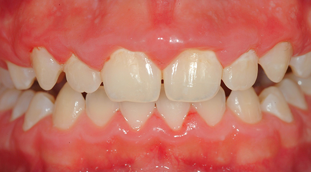 LA GINGIVITE TRAITEMENT ET SYMPT MES LABORATOIRE MEDIDENT LA GINGIVITE TRAITEMENT ET SYMPT MES LABORATOIRE MEDIDENT