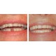 CREADENT dent provisoire: fabriquer et remplacer une dent manquante