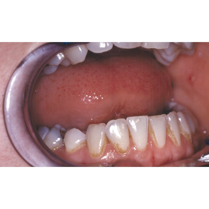 Gomme dentaire avec curette de détartrage,avec manche inoxydable