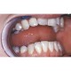 Gomme dentaire avec curette de détartrage - inoxydable