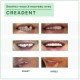 CREADENT dent provisoire: fabriquer et remplacer une dent manquante