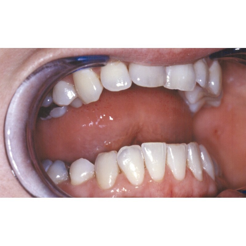 Excellente Prothèse Dentaire De La Mâchoire Inférieure Avec Gomme
