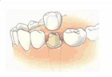 Ciment dentaire temporaire, appareil prothétique non eugénol, prothèses  dentaires, couronne arina, incrustations, superpositions,  DentrAndrTemporary, colle dentaire