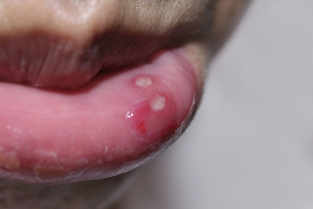 Aphtes Comment Soigner Un Aphte Dans La Bouche
