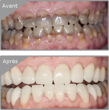 Refaire ses dents pas cher - Devis avec tarifs et photos avant-après