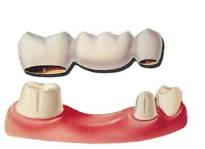 Prothèse dentaire fixe - Dentier, Bridge, Implant, Couronne - Prix et Usage