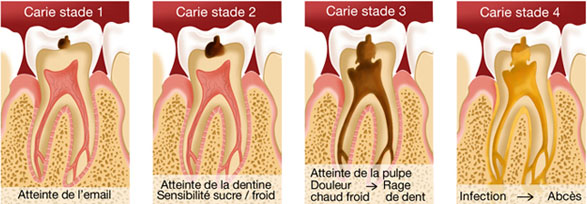 progression de la carie rage dent