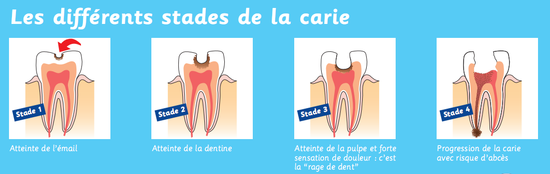 évolution de la carie