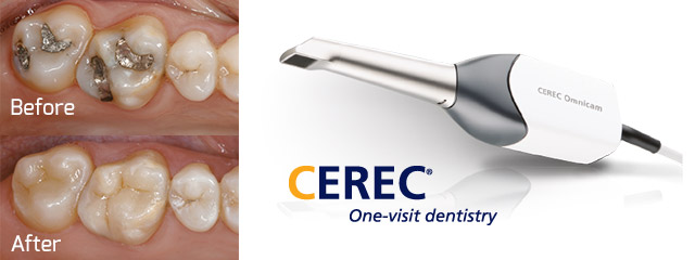 cerec