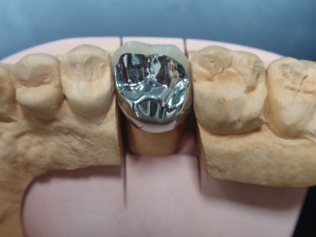 Couronne En Résine Pour Le Traitement Temporaire, Qui Sont Utilisés Dans  Les Cas Où Le Patient Doit Repartir Avec Les Dents Meulé Du Dentiste.  Ceux-ci Ont Un Rôle Protecteur Sur Les Dents