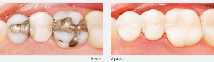 composite remplace un plombage