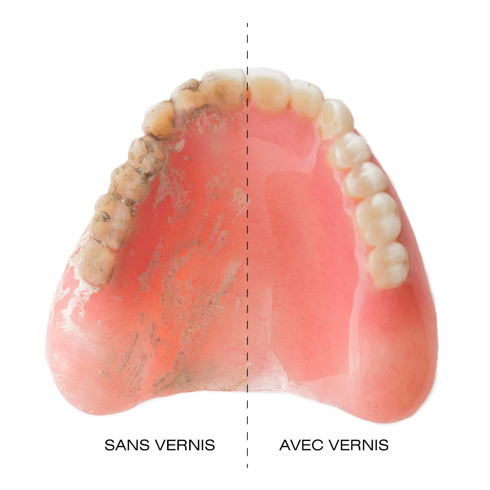 dentier avec vernis dentaire