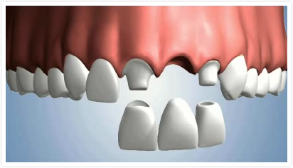 REMPLACER une dent manquante avec FABRICADENT  20 créations de dents provisoires 