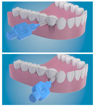 dentifrice pour implant