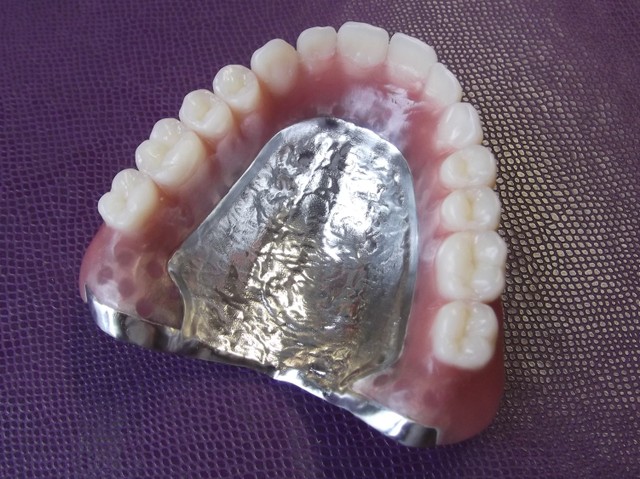 plaque metallique pour dentier