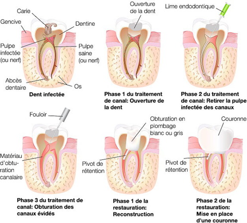 pulpectomie