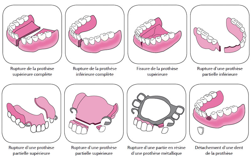 Dents pour dentier .Réparer un appareil dentaire ou rajouter une dent