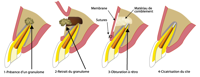 resection apicale traitement