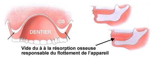 resoprtion osseuse