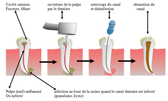 PANSEMENT DENTAIRE CIMADENT pour boucher une carie ou une