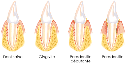 gingivite